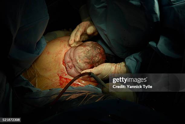 cesarean section - kassel stock-fotos und bilder