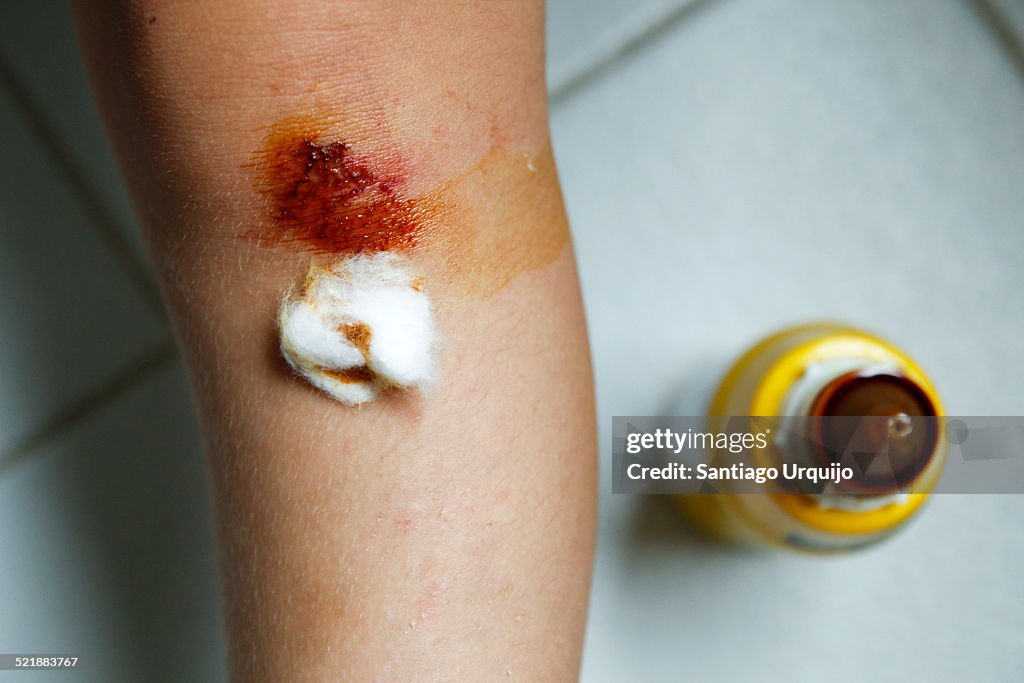 Child's leg with a bleeding injury