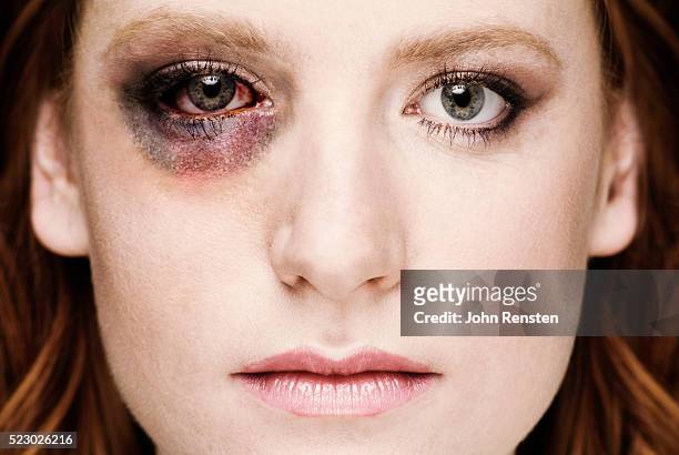 young woman with black eye - women bruise stock pictures, royalty-free photos & images