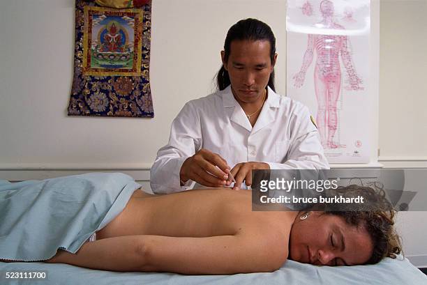 acupuncturist inserting needles - acupuncture photos et images de collection