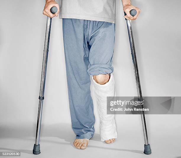 man with a broken leg - cast stockfoto's en -beelden