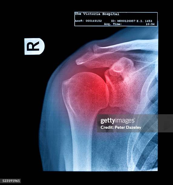 x-ray showing frozen shoulder - human bone stock pictures, royalty-free photos & images