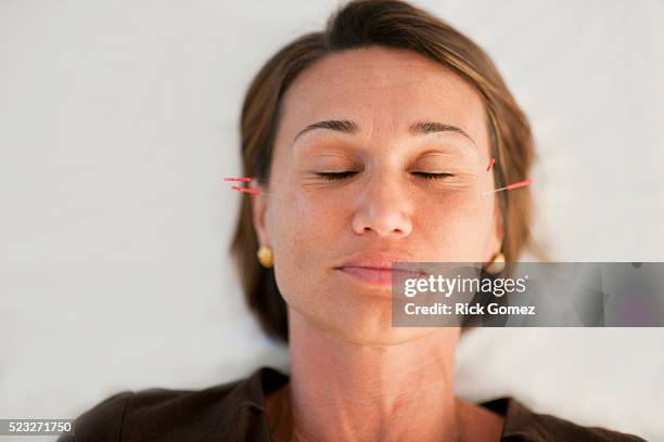 woman getting acupuncture - acupuncture photos et images de collection