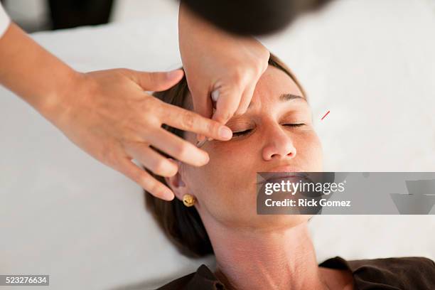 woman getting acupuncture - acupuncture stock pictures, royalty-free photos & images