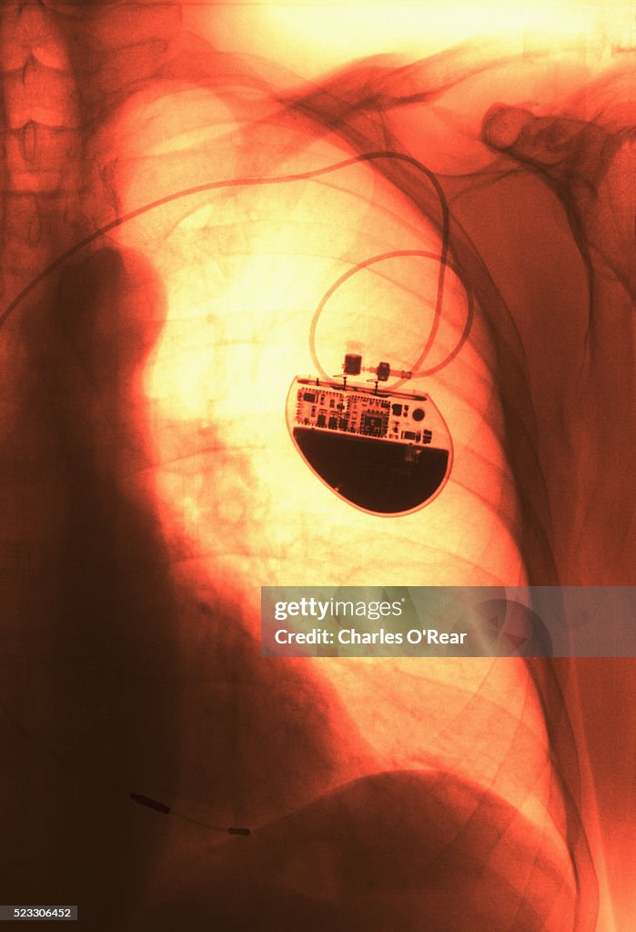 Xray Showing Pacemaker High-Res Stock Photo - Getty Images