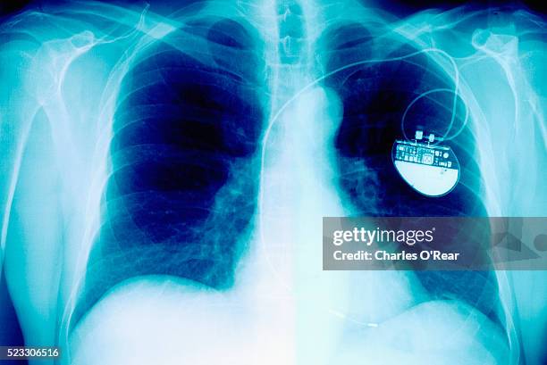 Foto Pacemaker 274 Pacemaker Ecg Stock Photos, High-Res Pictures, and Images - Getty ...