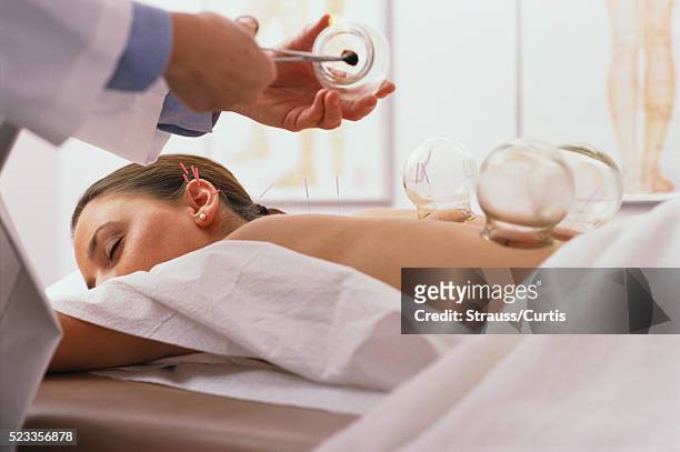 woman receiving cupping and acupuncture treatment - acupuncture stock-fotos und bilder