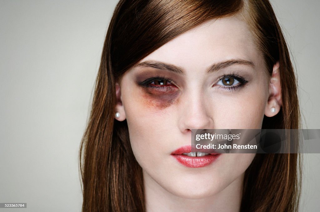 Young Woman with Black Eye