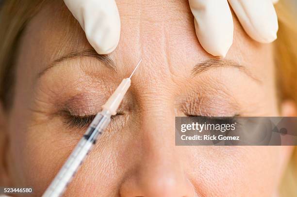 woman receiving botox injection - botoxinjektion bildbanksfoton och bilder