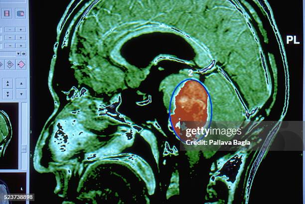 magnetic resonance image of the head - brain tumour stock pictures, royalty-free photos & images