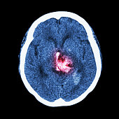 CT scan of brain : show hemorrhagic stroke