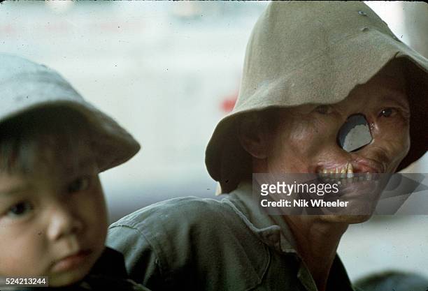 Vietnamese man suffering from leprosy holding a small child in the central highlands of Vietnam.