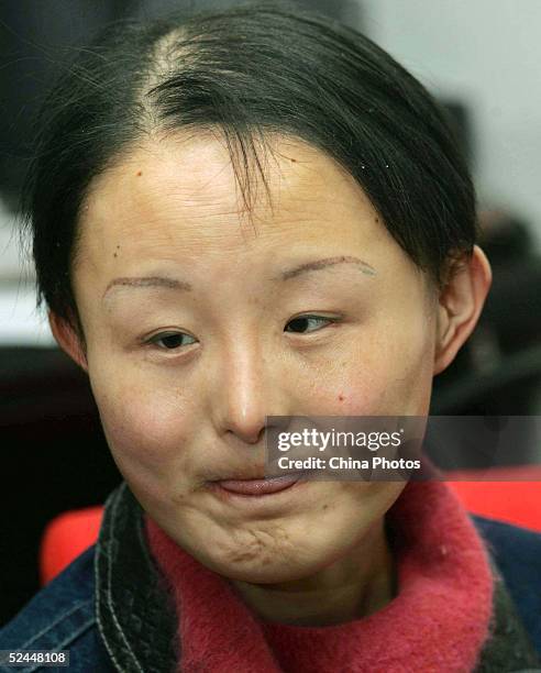 Chinese woman Zhang Jing, known as the "Ugly Girl" relaxes before surgery at a plastic surgery hospital on March 18, 2005 in Shanghai, China. Zhang...