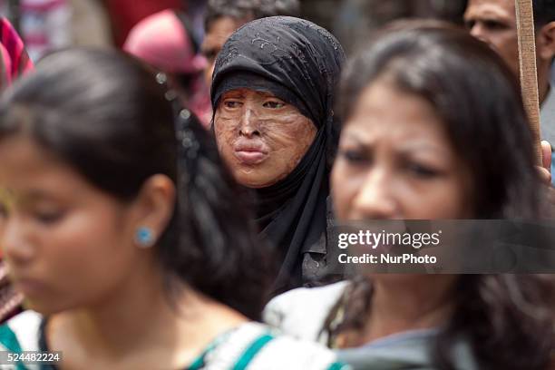 May 12 : Survivors of acid attacks, attend a human chain to protest acid attacks and torture of women in Dhaka on 12th May 2015. According to Acid...