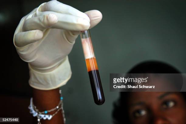 Jean Louis looks at a blood sample March 24, 2005 before it will tested at the lab of Zanmi Lasante Hospital in Cange, Haiti. Many HIV positive...