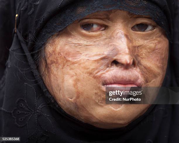 May 12 : Survivors of acid attacks, attend a human chain to protest acid attacks and torture of women in Dhaka on 12th May 2015. According to Acid...