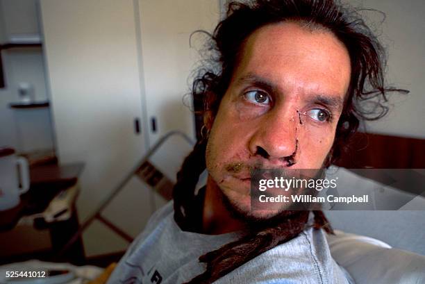 Jesshua Amun recovering in the Eastern Idaho Medical Center after being attacked by a female grizzly bear near West Yellowstone , Montana in late...