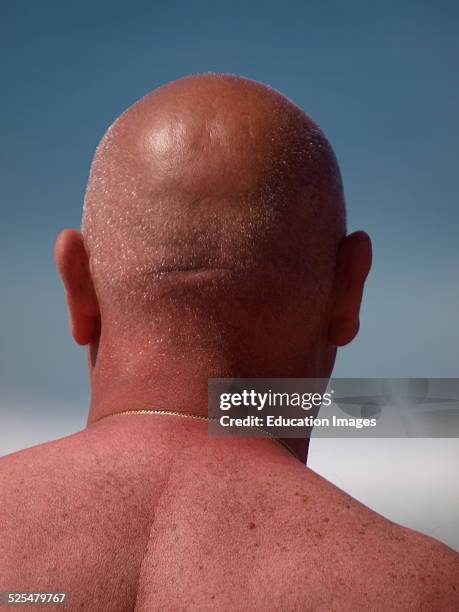 Bald headed man going red in the sun, Cornwall, UK.