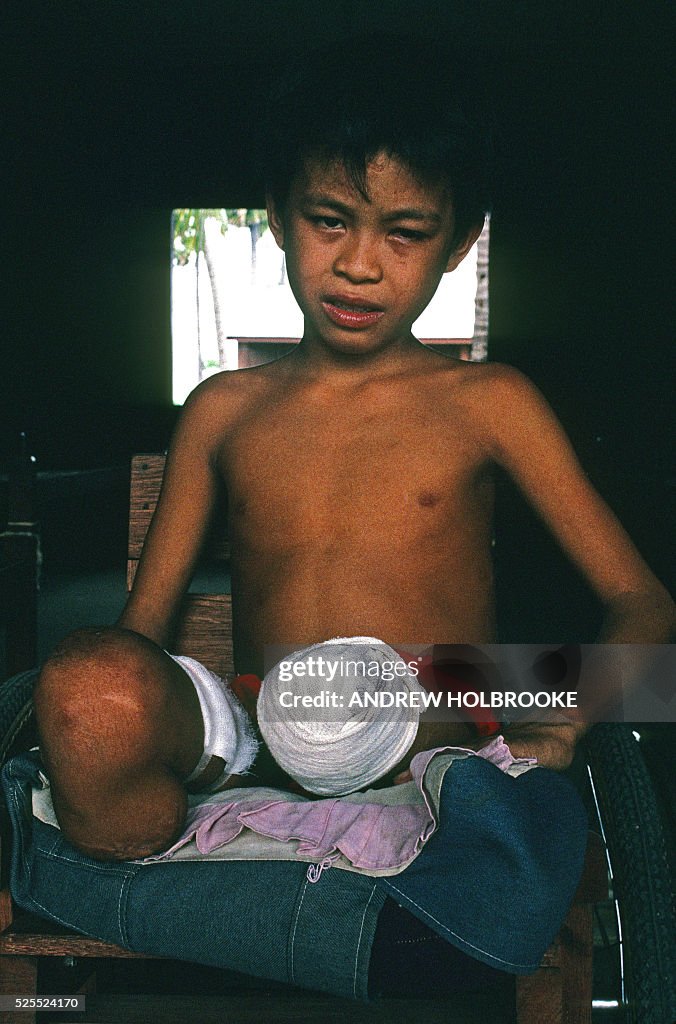 Child Landmine Victim in Cambodia