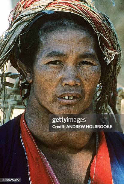 Palaung tribal woman with a Goiter, usually a symptom of iodine deficiency.