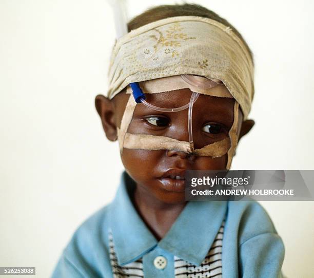 August 1992 - A malnourished, dehydrated child being fed through a tube inserted into the nasal passage.