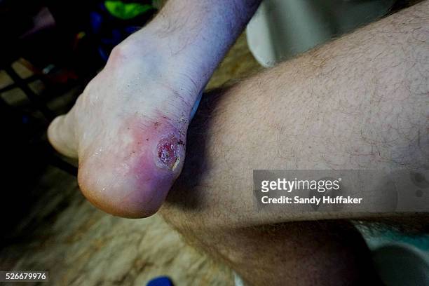 BackpackerDouglas Hosking displays a large blister he got while hiking the PCT at the Warner Springs Community Resource Center along the Pacific...