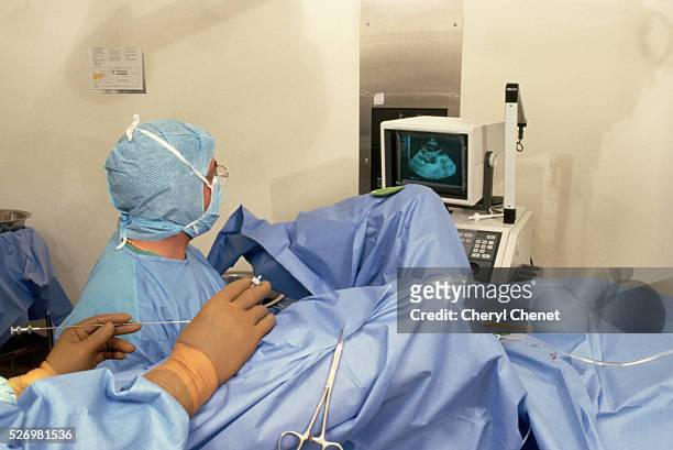 Surgeon removes a woman's eggs to start the process of in vitro fertilization.