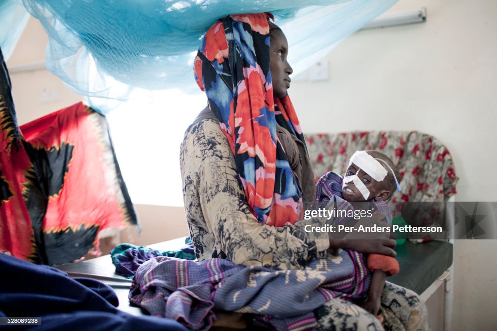 Malnourished girl in hospital, Dadaab, Kenya