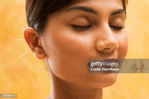 young woman getting acupuncture treatment - acupuncture needle 個照片及圖片檔