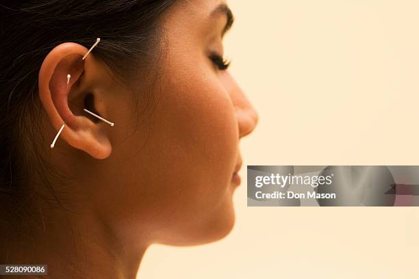 young woman getting acupuncture treatment - agopuntura foto e immagini stock