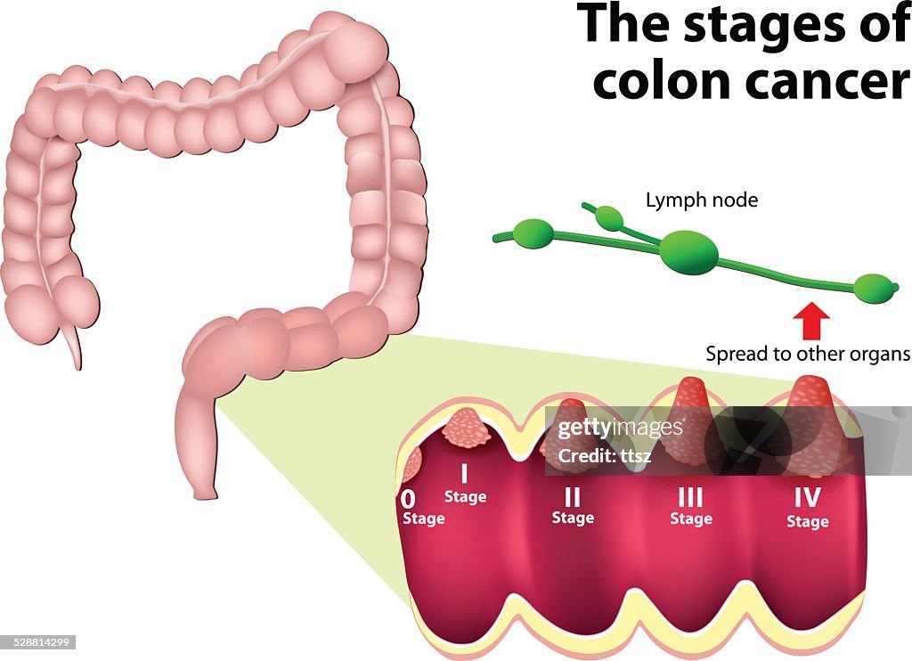 The Stages Of Colorectal Cancer HighRes Vector Graphic Getty Images