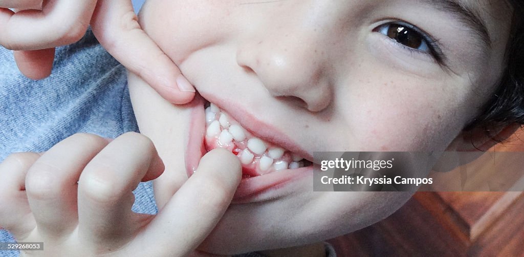 Boy pointing with fingers his first tooth loss