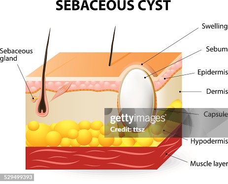 Sebaceous C Sebaceous Cyst Diagram