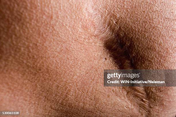 close-up of a scar on a person's skin - cicatriz imagens e fotografias de stock