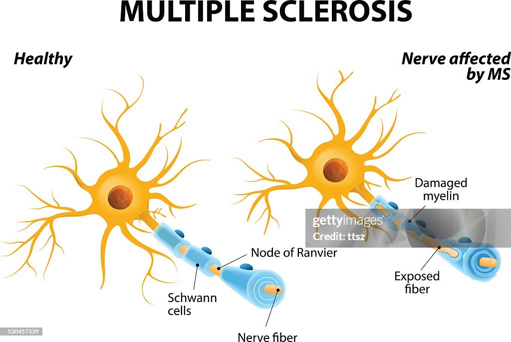 Multiple Sclerosis