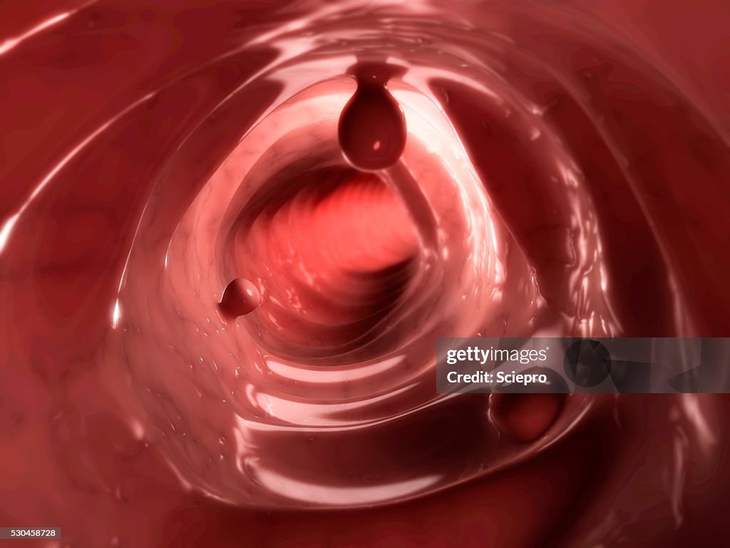 Colon polyps, artwork