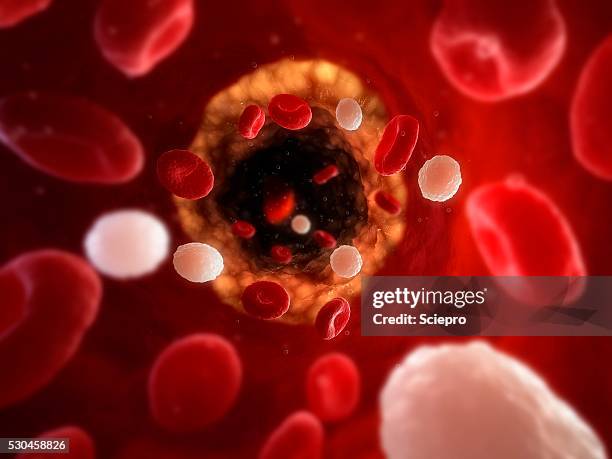 narrowed artery, artwork - arteriosklerose stock-fotos und bilder