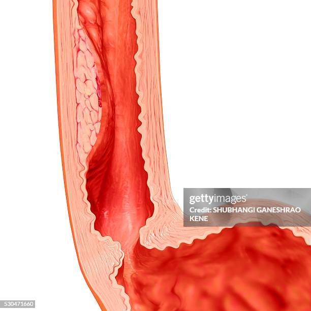 barrett oesophagus symptoms, computer artwork. - slokdarm stockfoto's en -beelden