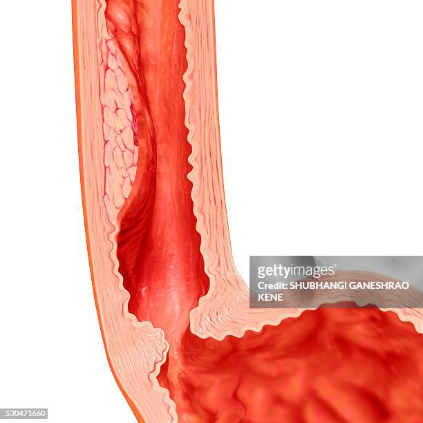 barrett oesophagus symptoms, computer artwork. - oesophagus stock pictures, royalty-free photos & images