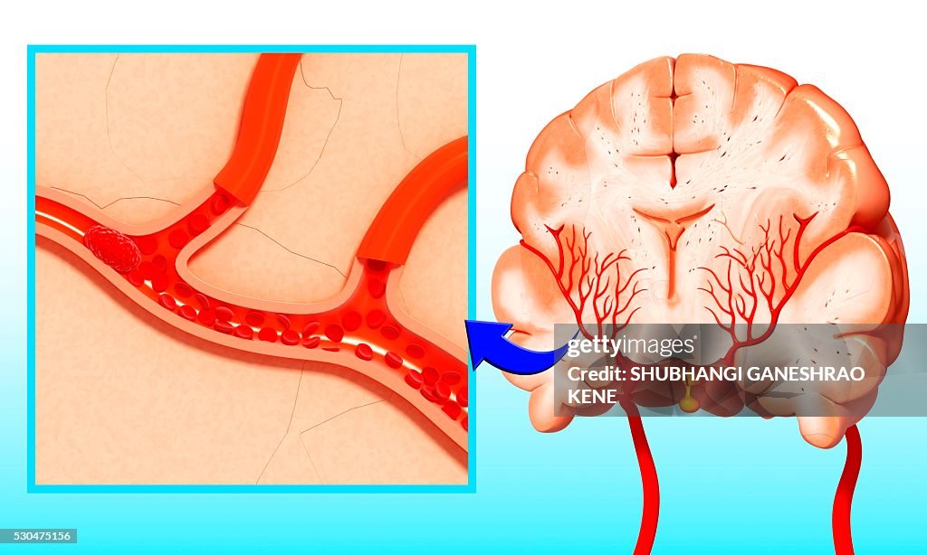 Brain epidural hematoma, computer artwork.