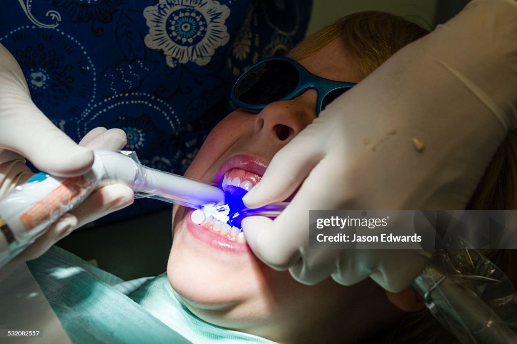 A dentist uses an ultra violet light to set composite fillings in the molars of a young boy.