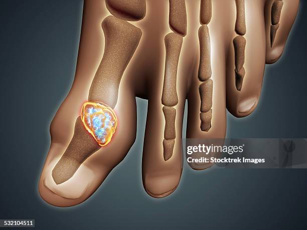 conceptual image of gout in the big toe. - rheumatismus stock-grafiken, -clipart, -cartoons und -symbole