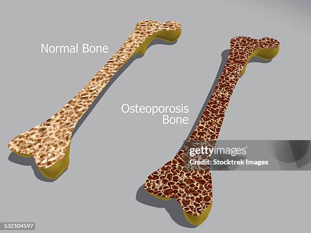 comparison of a healthy bone and a bone with osteoporosis. - osteoporose stock-grafiken, -clipart, -cartoons und -symbole