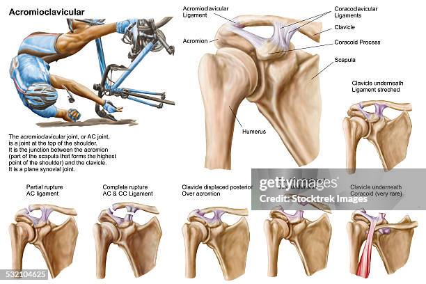 ilustrações, clipart, desenhos animados e ícones de anatomy of acromioclavicular joint rupture and displacement. - clavicle