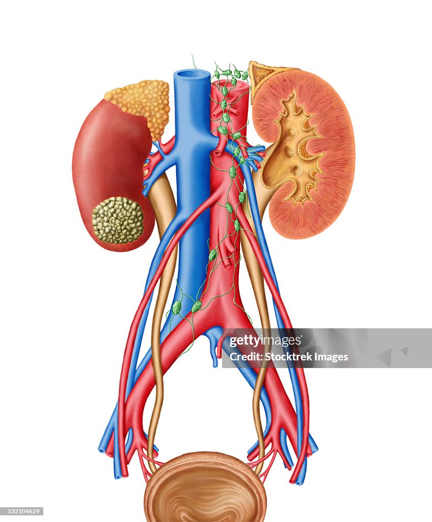 Early stage of kidney cancer with a tumor visible on the kidney.