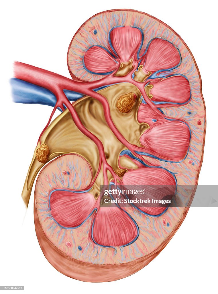 Large staghorn calculus in the human kidney.