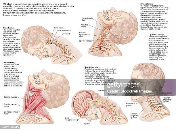 medical chart showing the range of injuries to the human neck caused by whiplash. - neck muscle pain illustration stock illustrations