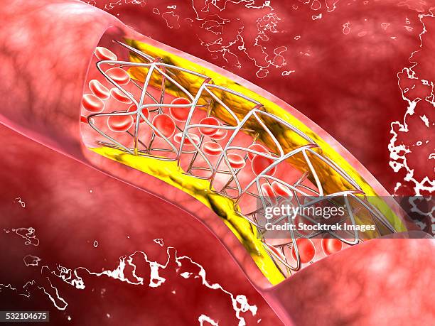 Fat Dissection 429 Artery Dissection Stock Photos, High-Res Pictures, and Images ...