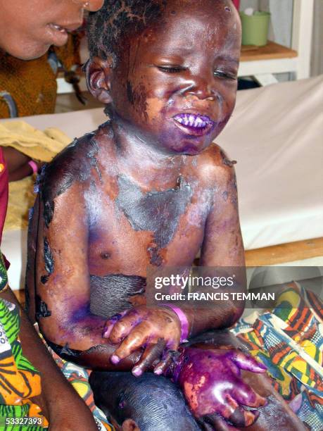 Aminou, a four-year Nigerois boy suffering from Kwashiorkor, sits on a bed, next to his mother, 31 July 2005 at the Medecins Sans Frontieres...