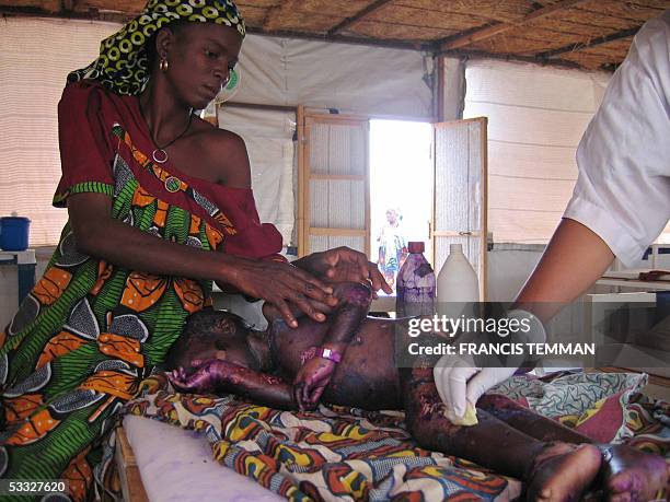 Aminou, a four-year Nigerois boy suffering from Kwashiorkor, lies on a bed with his mother next to him, while being treated 31 July 2005 at the...